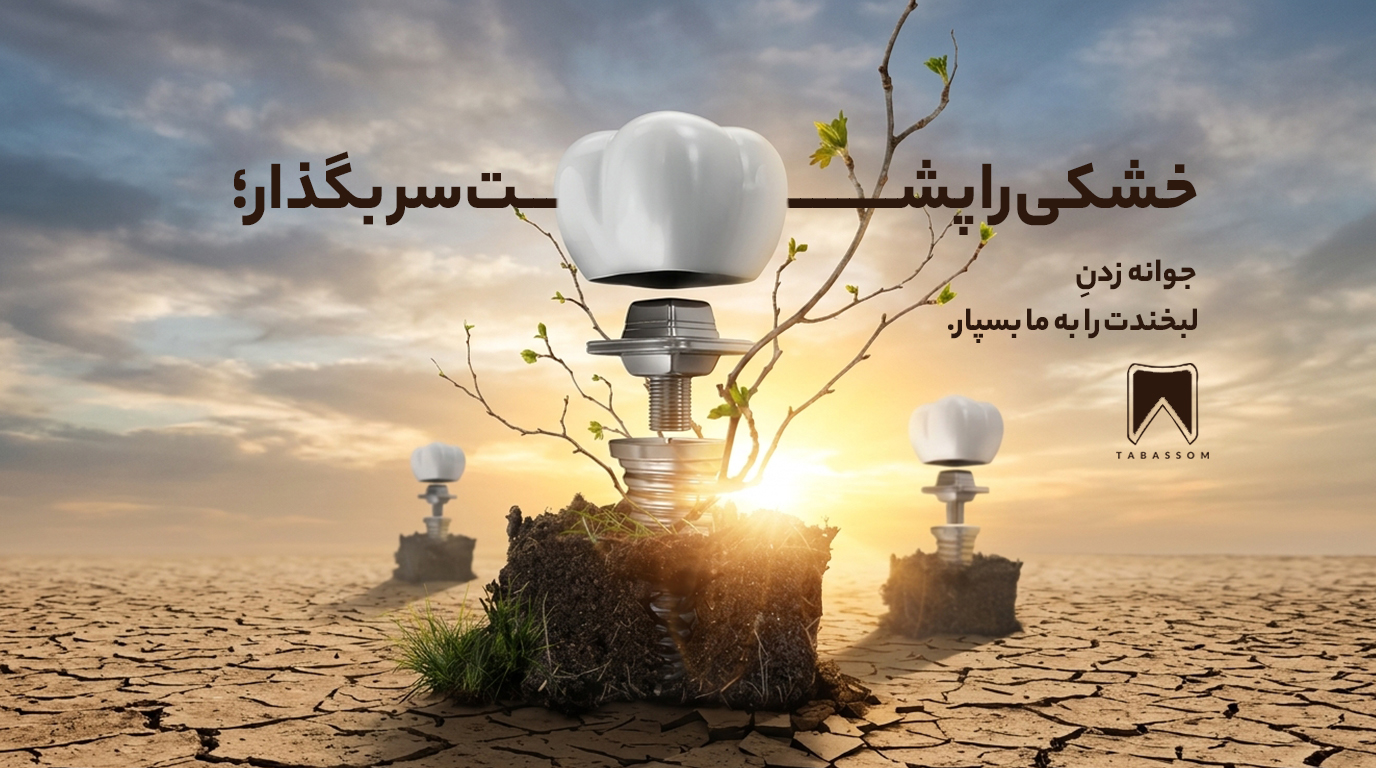 ایمپلنت